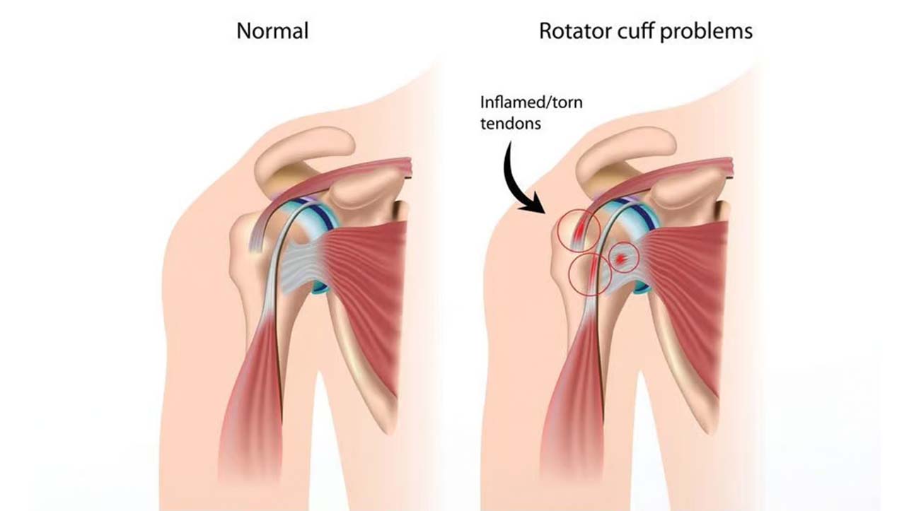 The 9 Most Common Badminton Injuries and How to Prevent Them